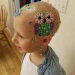 alopecia-crianca (1)
