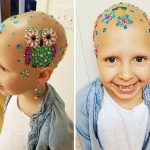 alopecia-crianca (1)