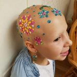 alopecia-crianca (2)